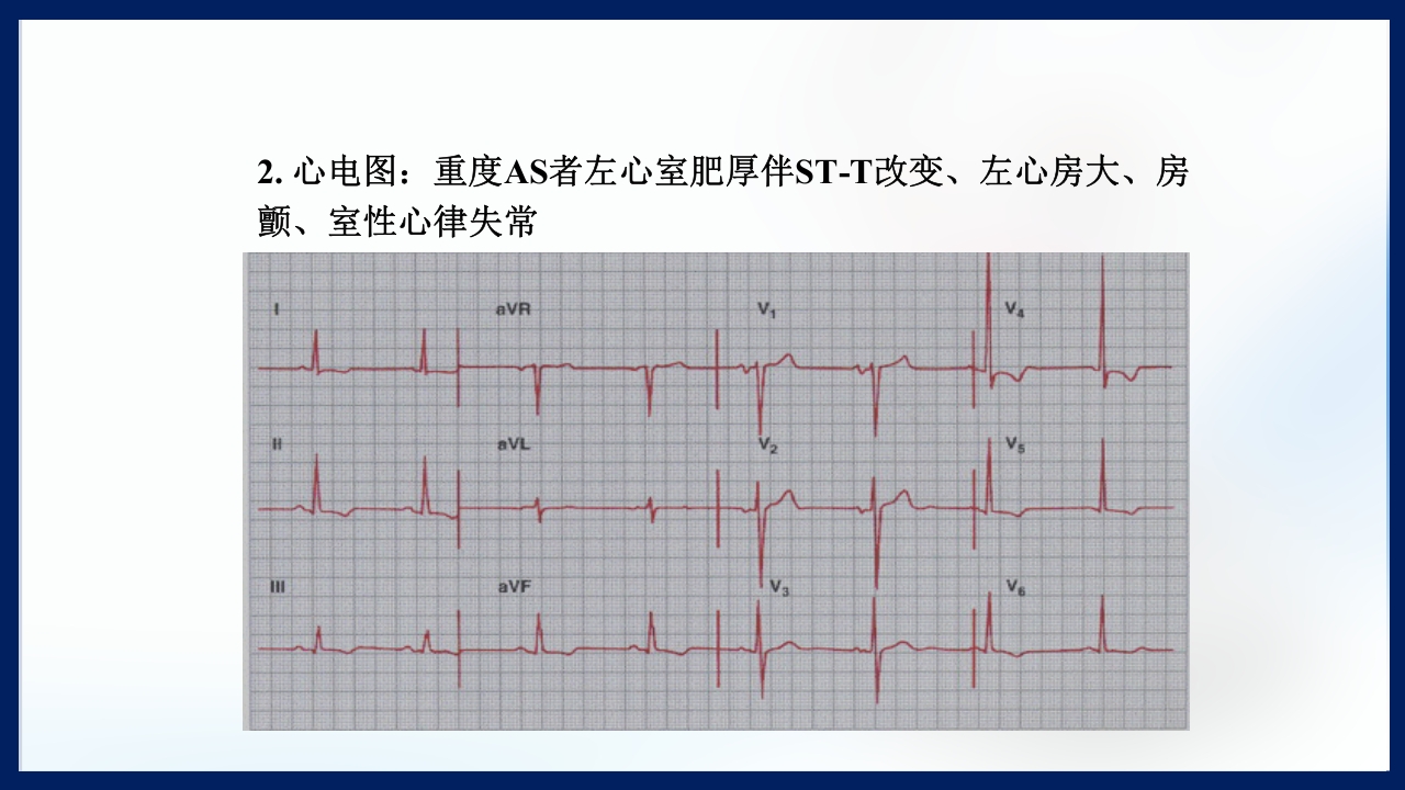 心脏瓣膜病PPT课件下载69