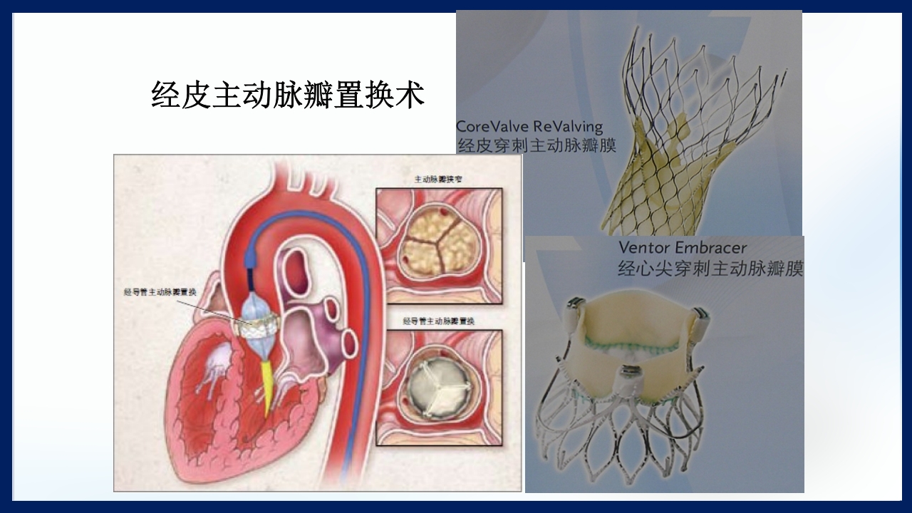 心脏瓣膜病PPT课件下载77