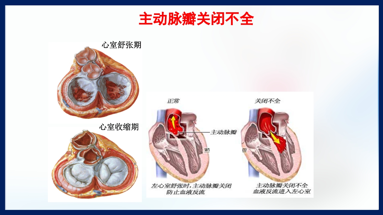 心脏瓣膜病PPT课件下载79