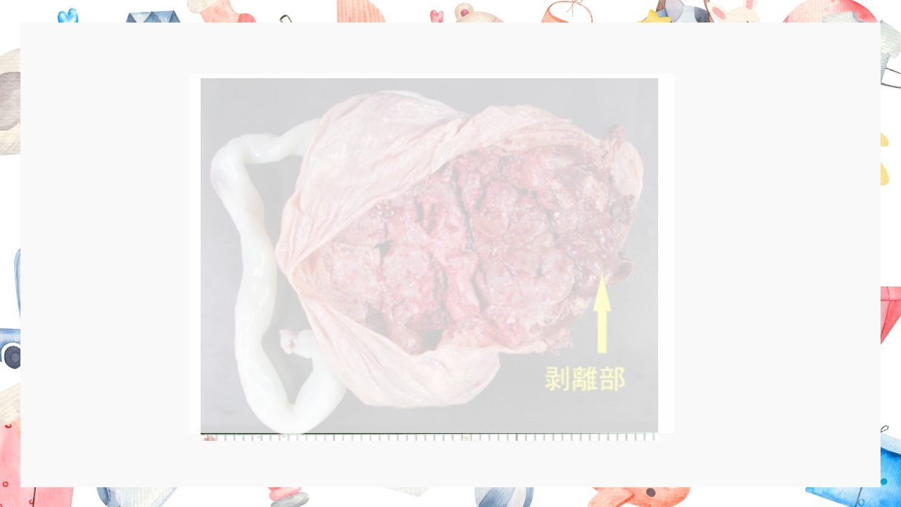 胎盘早剥护理PPT课件28