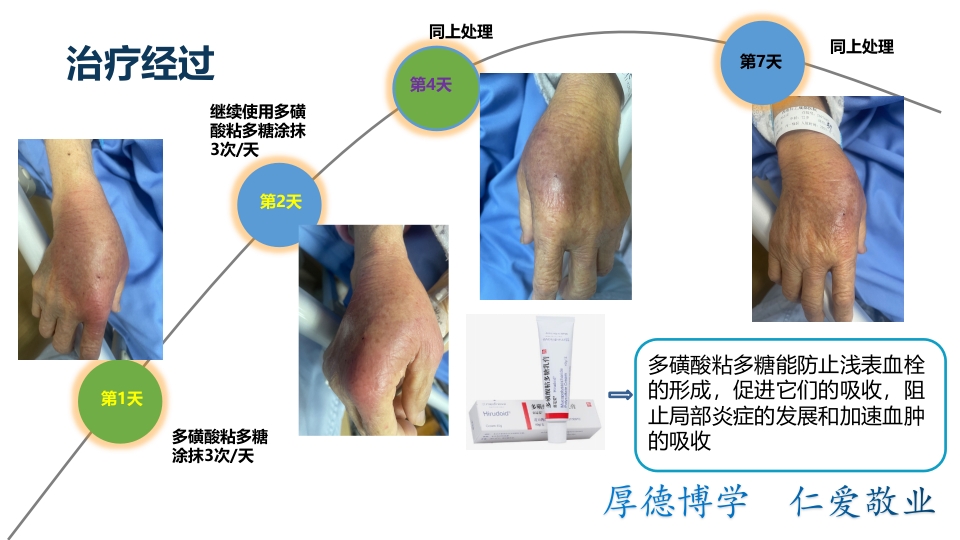药物外渗案例分析汇报PPT课件下载4