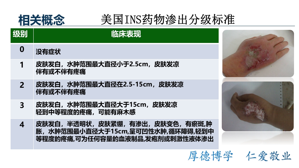 药物外渗案例分析汇报PPT课件下载5