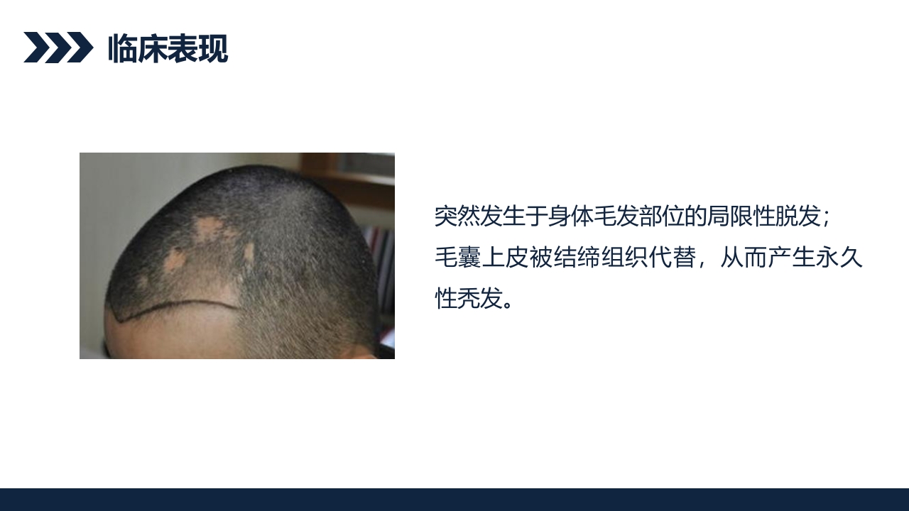 瘢痕性脱发患者护理查房PPT课件6