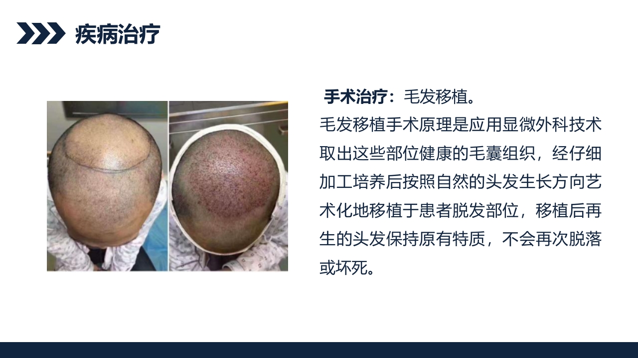 瘢痕性脱发患者护理查房PPT课件8