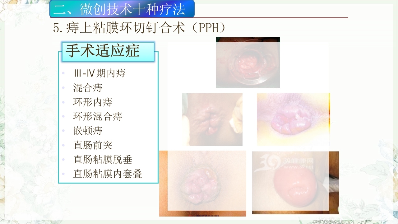 痔疮的微创手术PPT课件17