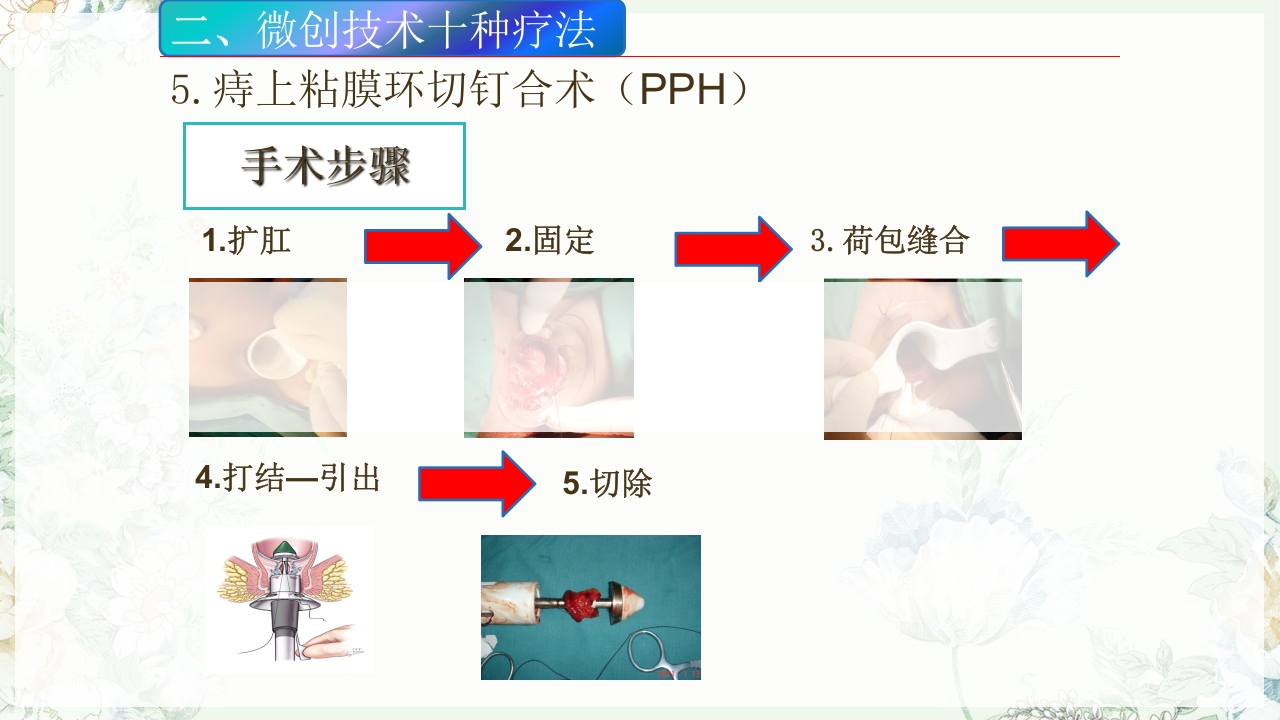 痔疮的微创手术PPT课件18