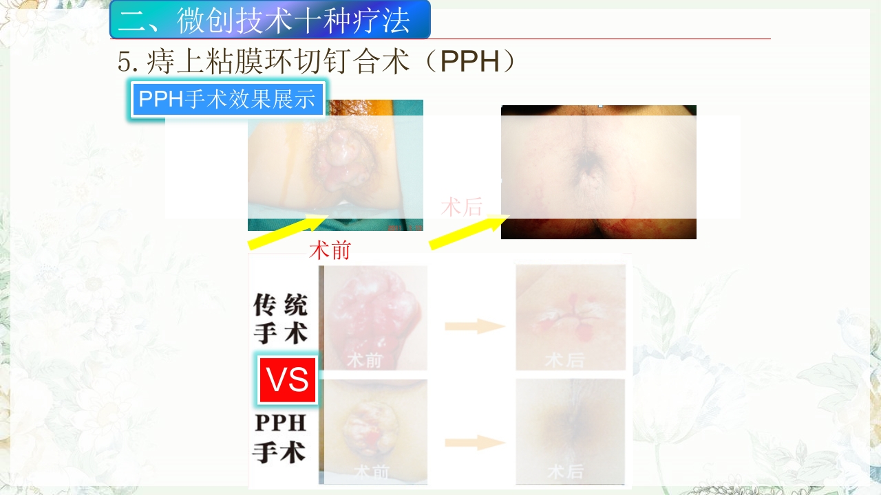 痔疮的微创手术PPT课件19