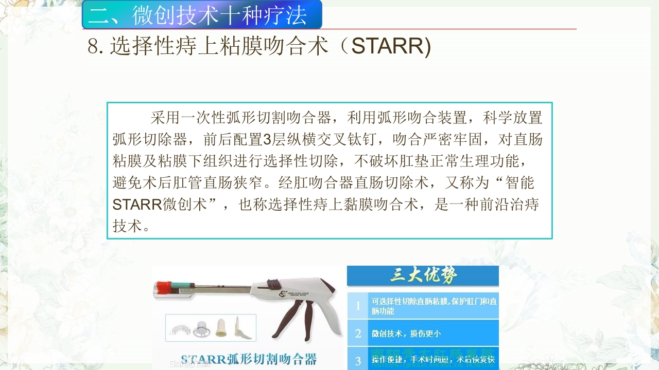 痔疮的微创手术PPT课件24