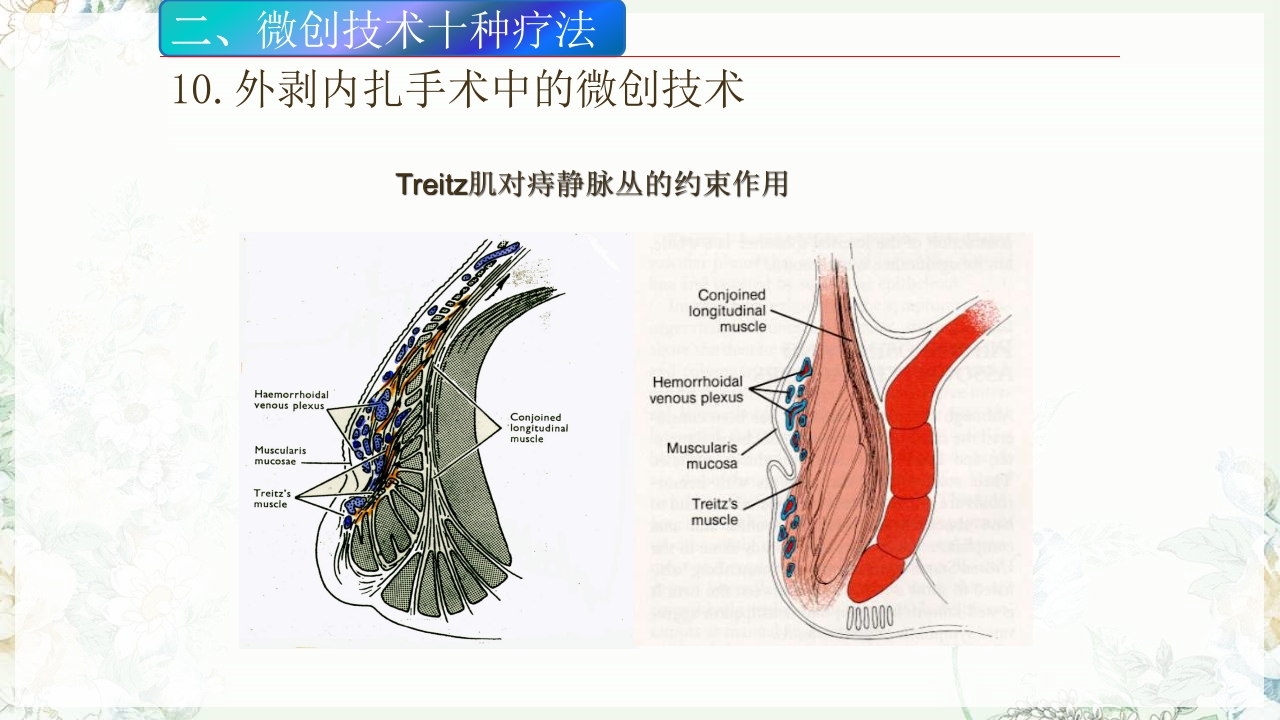 痔疮的微创手术PPT课件34
