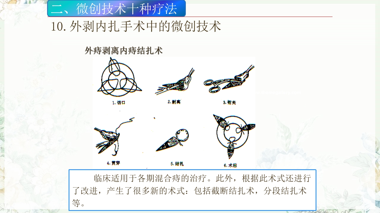 痔疮的微创手术PPT课件36