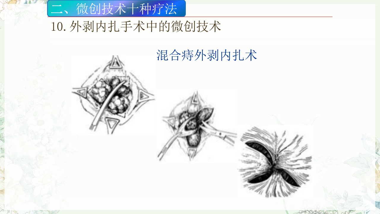 痔疮的微创手术PPT课件37