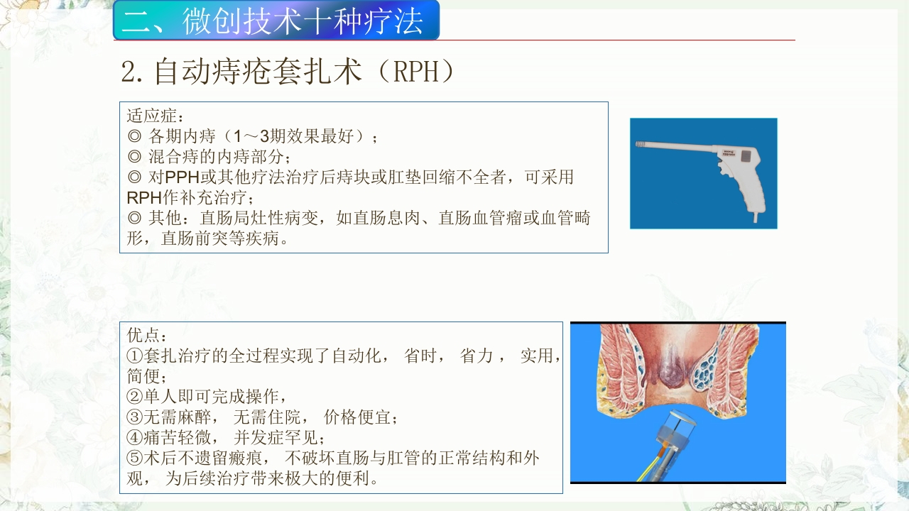 痔疮的微创手术PPT课件5