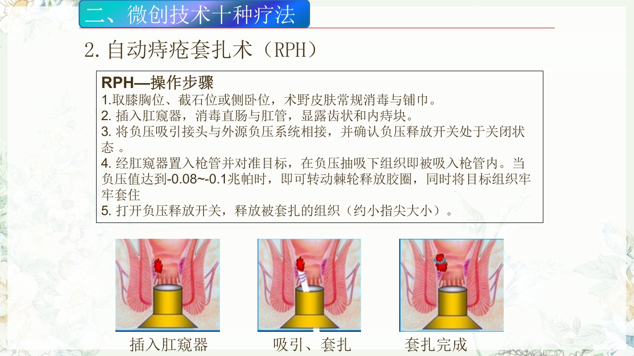 痔疮的微创手术PPT课件6