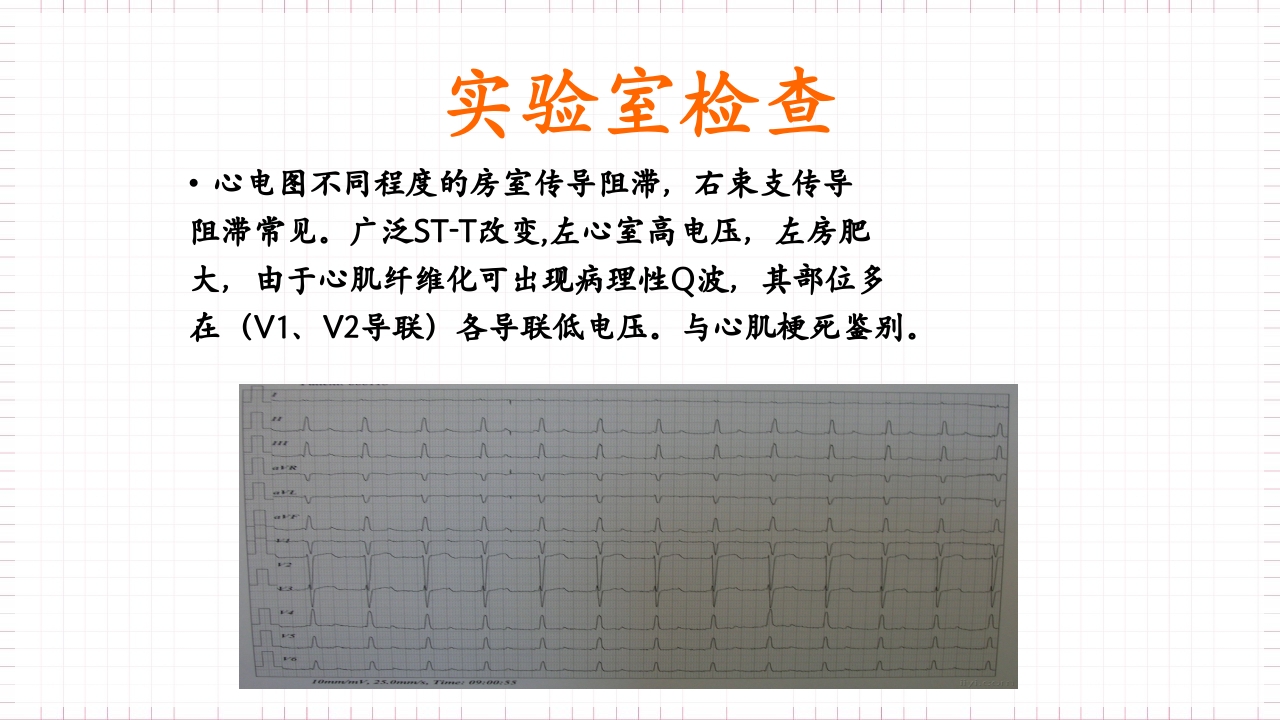 扩张型心肌病的护理PPT课件下载13