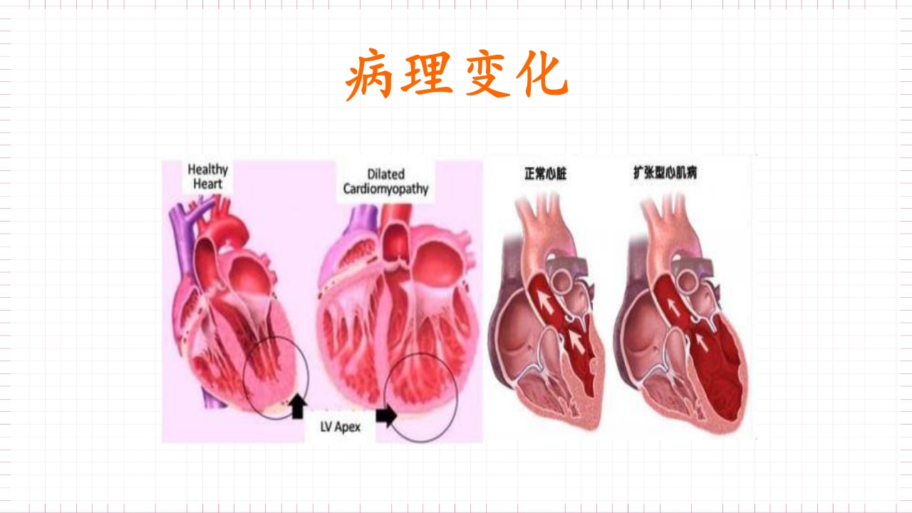 扩张型心肌病的护理PPT课件下载7