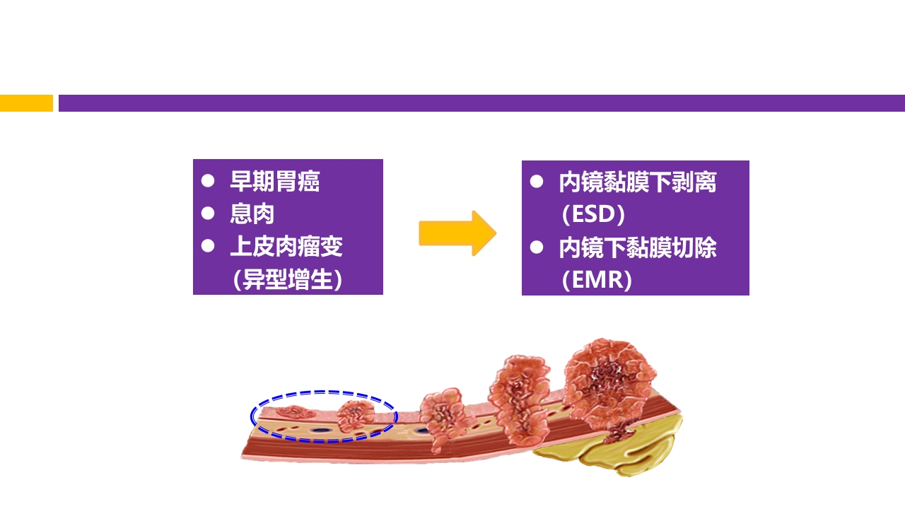 中国第五次幽门螺旋杆菌感染诊治共识解读PPT10