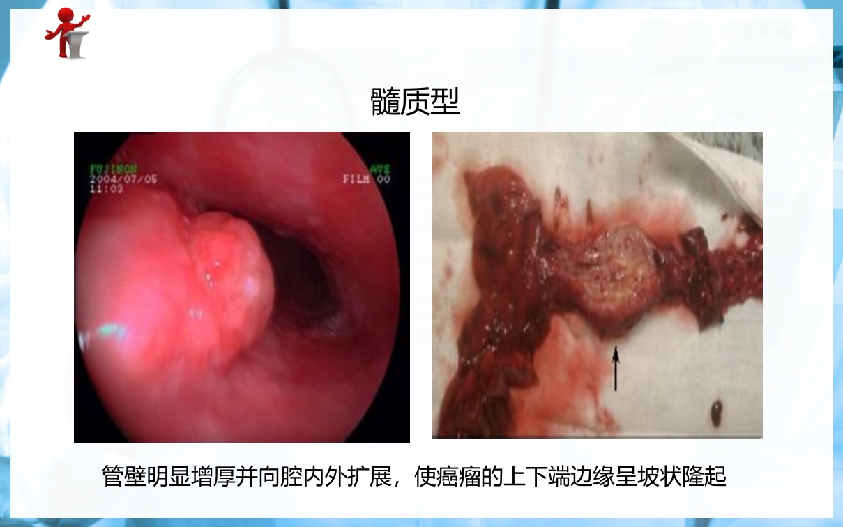 食管癌病人的护理PPT课件下载5