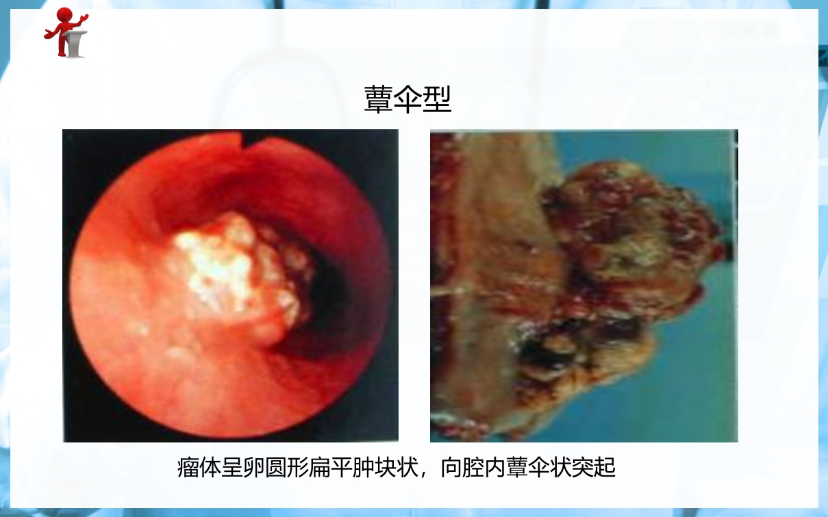 食管癌病人的护理PPT课件下载6