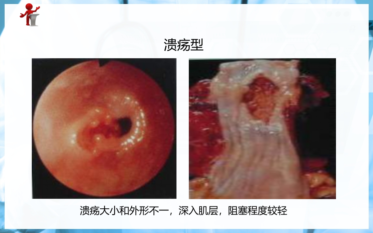 食管癌病人的护理PPT课件下载7
