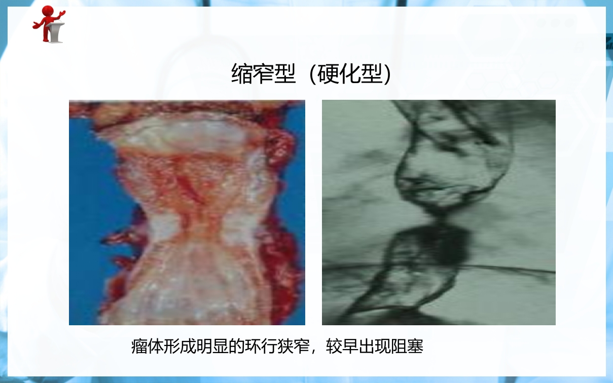 食管癌病人的护理PPT课件下载8