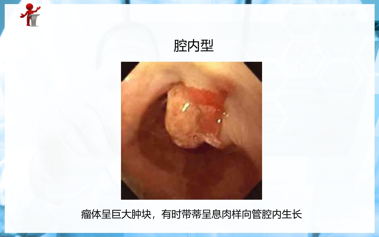 食管癌病人的护理PPT课件下载9