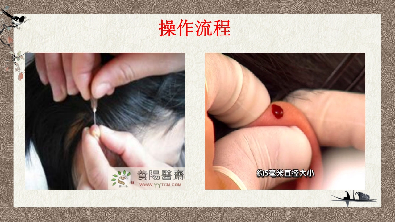 中医耳尖放血疗法PPT课件10