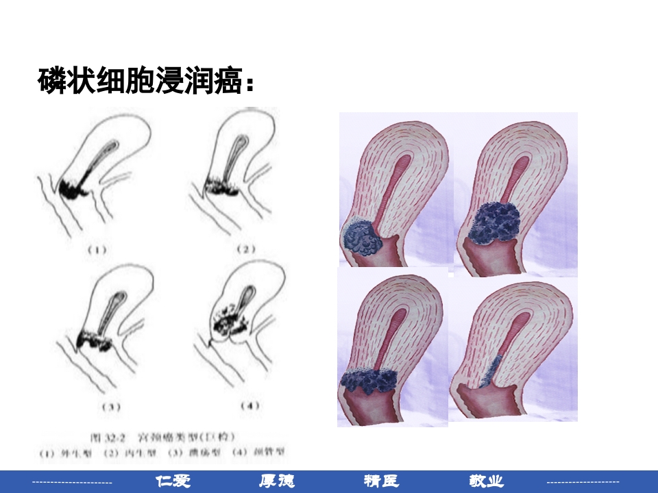 宫颈癌患者护理常规PPT课件9