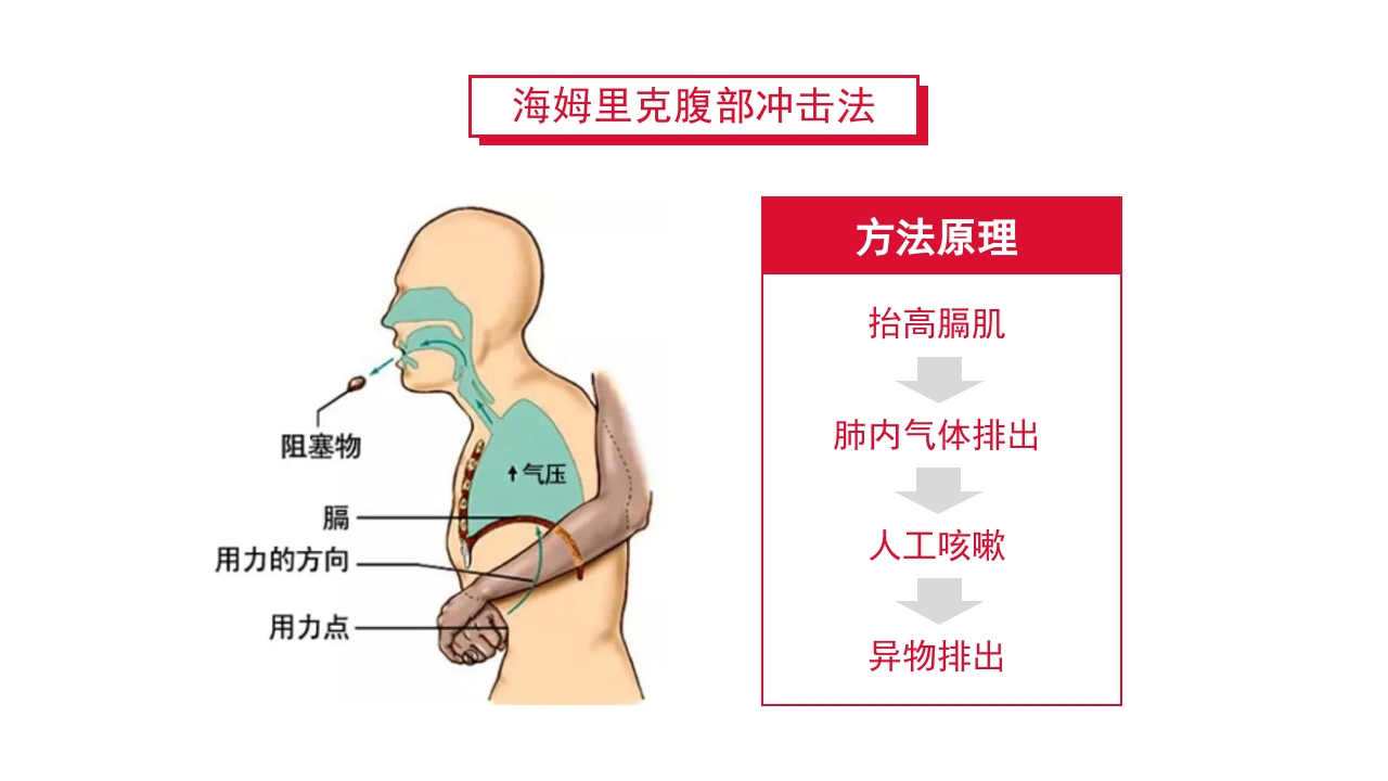 紧急解除气道梗阻瞬间挽救生命海姆里克腹部冲击法PPT课件13