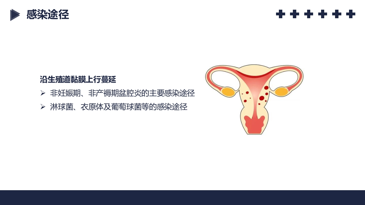 盆腔炎知识介绍PPT课件12