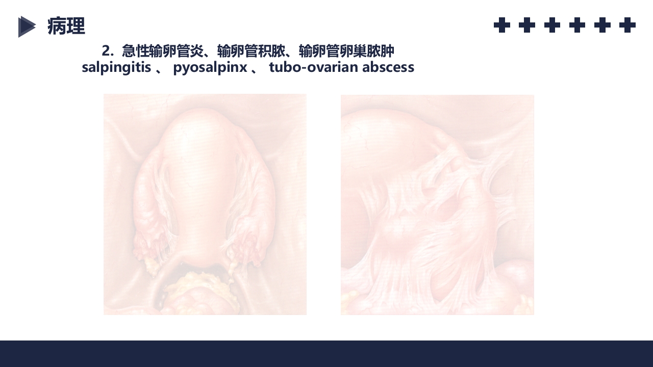 盆腔炎知识介绍PPT课件19