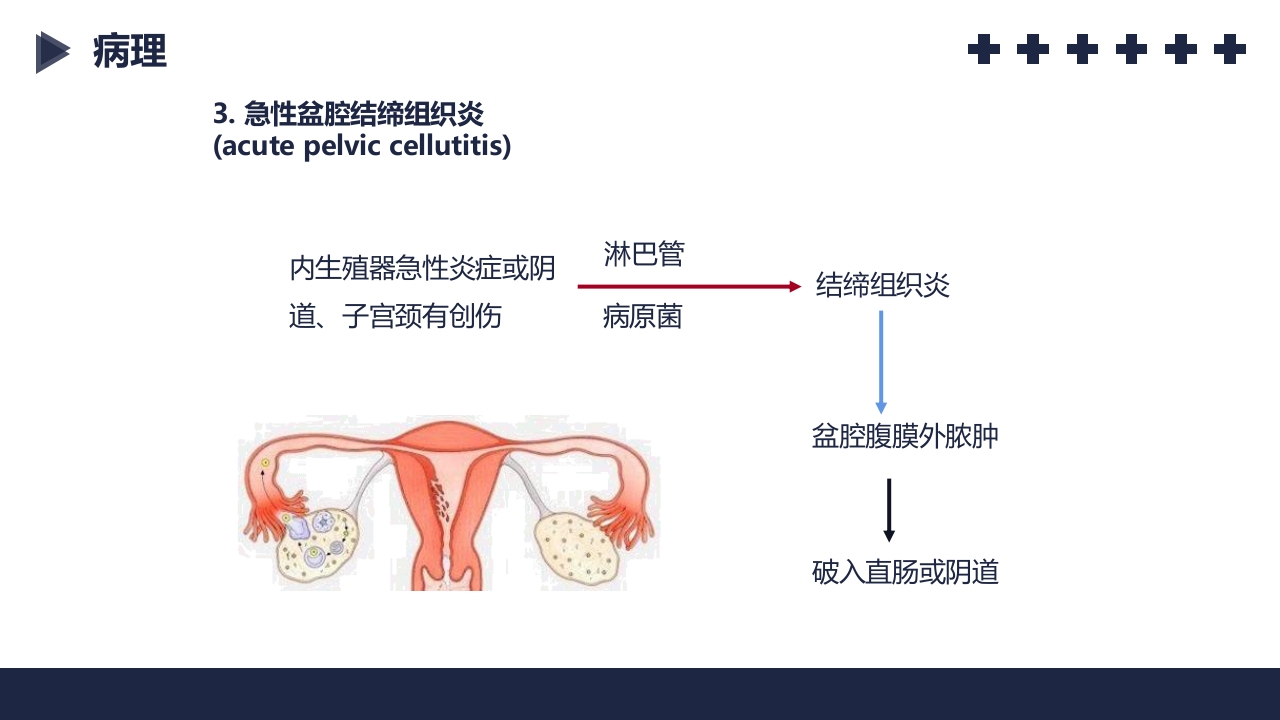 盆腔炎知识介绍PPT课件21