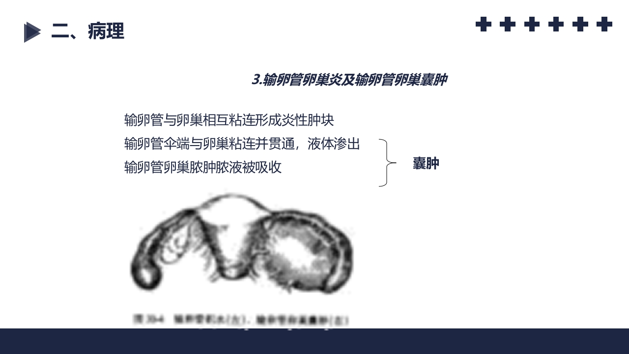 盆腔炎知识介绍PPT课件45