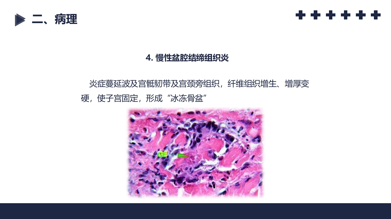 盆腔炎知识介绍PPT课件46