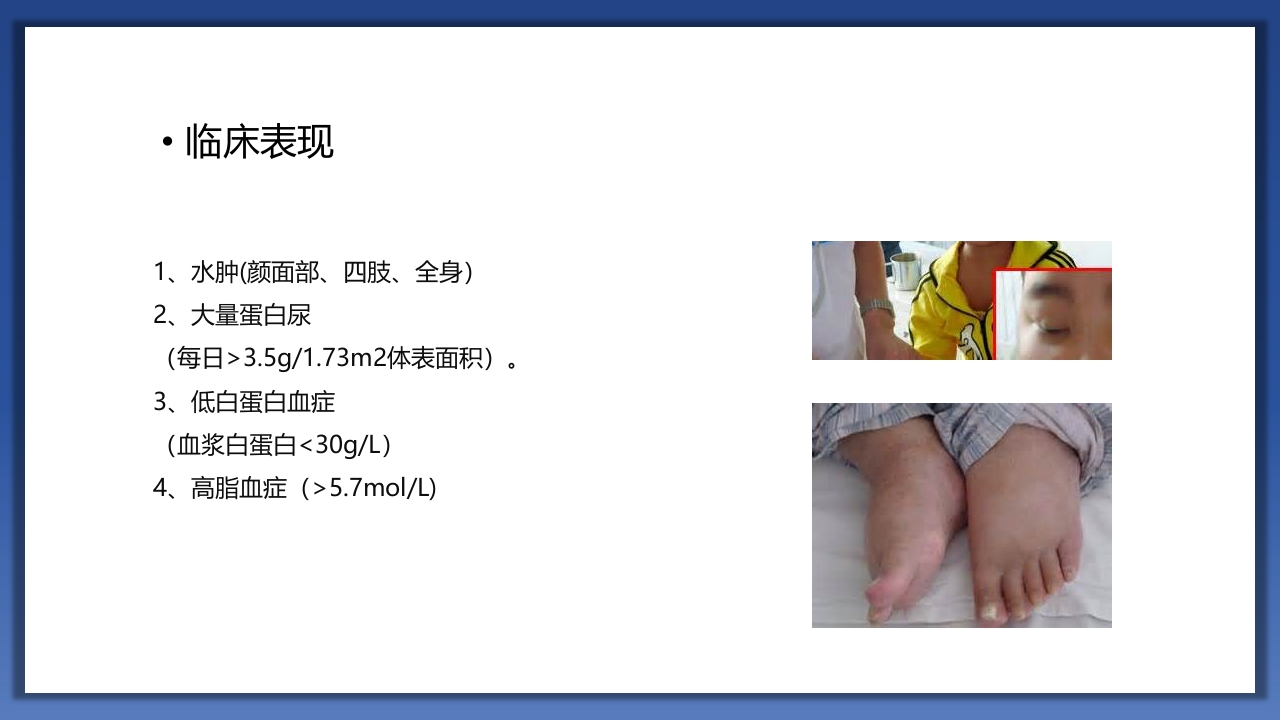 小儿肾病综合征护理查房PPT课件6
