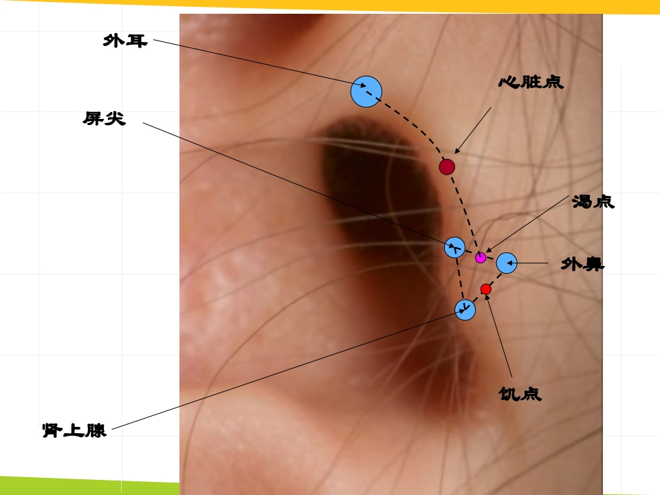 耳穴埋豆与常见病取穴·讲座课件PPT课件40