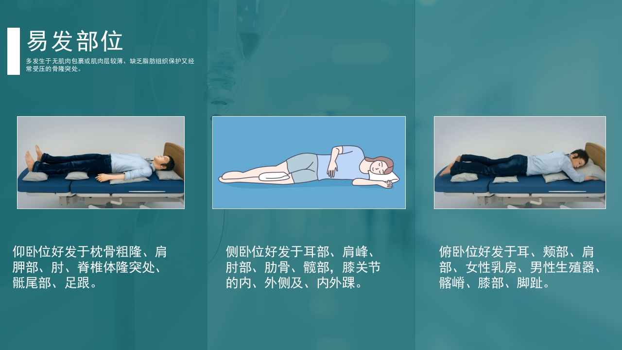 关于跌倒坠床压疮防范及护理措施PPT课件14