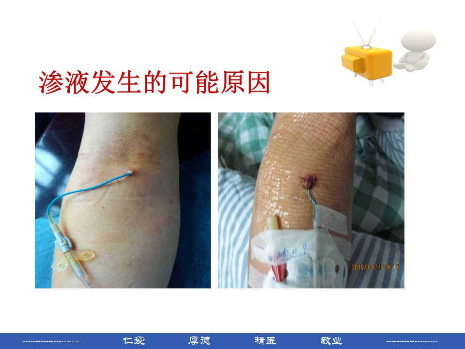 PICC穿刺点渗液与皮肤过敏的处理PPT课件10