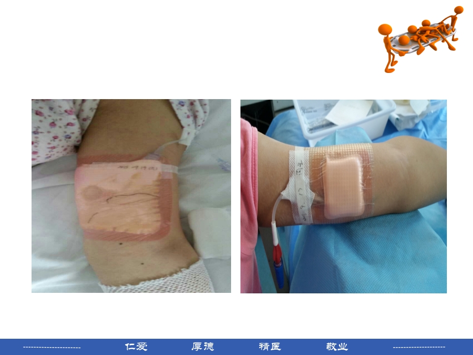 PICC穿刺点渗液与皮肤过敏的处理PPT课件17