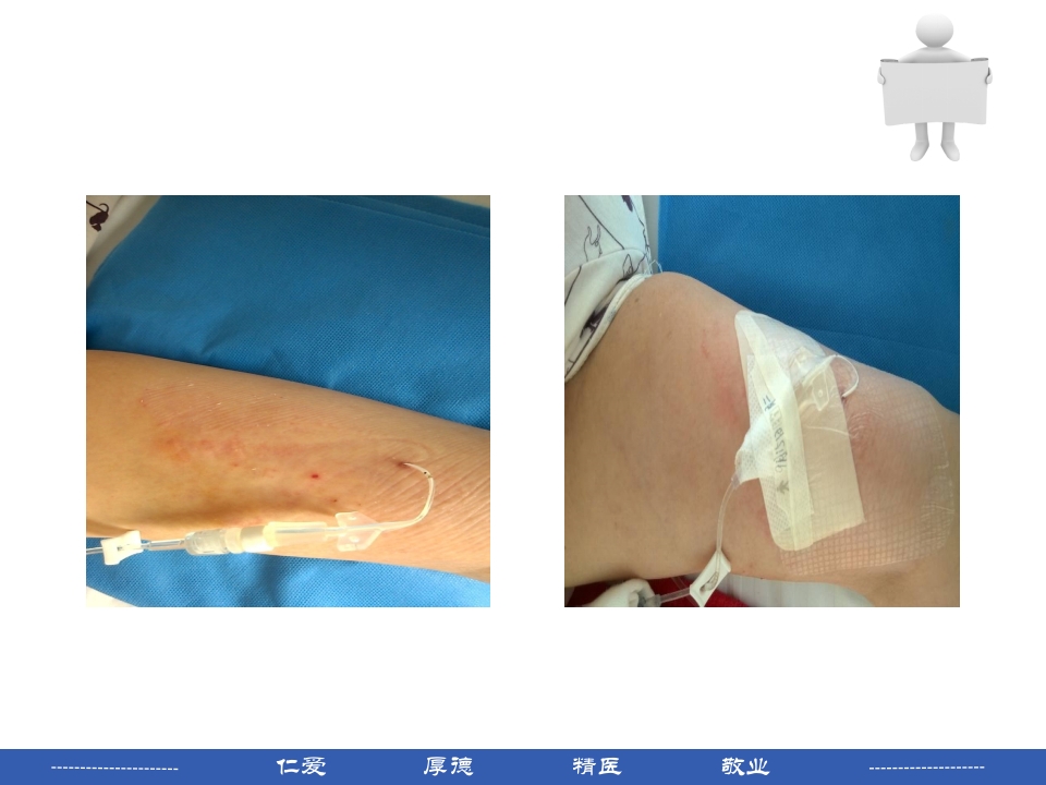 PICC穿刺点渗液与皮肤过敏的处理PPT课件21