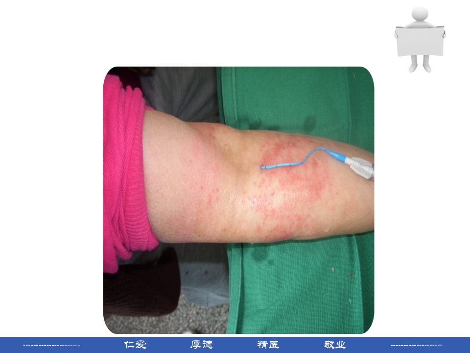 PICC穿刺点渗液与皮肤过敏的处理PPT课件22