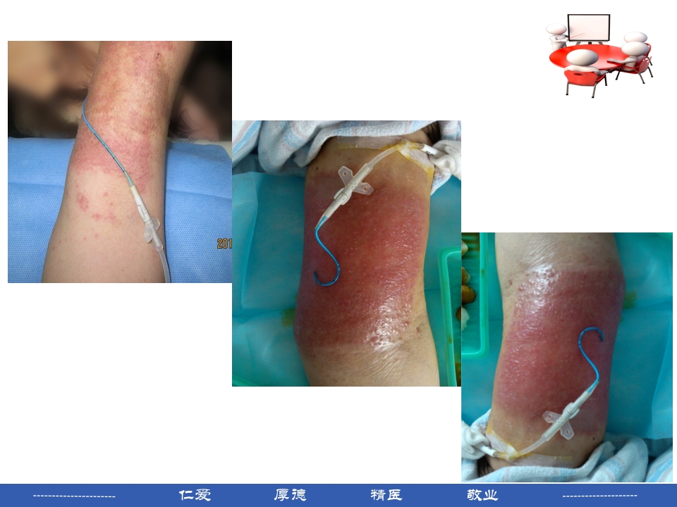 PICC穿刺点渗液与皮肤过敏的处理PPT课件23