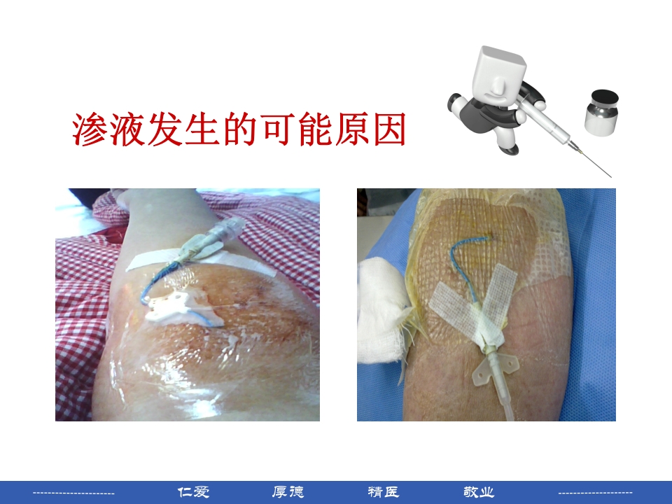 PICC穿刺点渗液与皮肤过敏的处理PPT课件9
