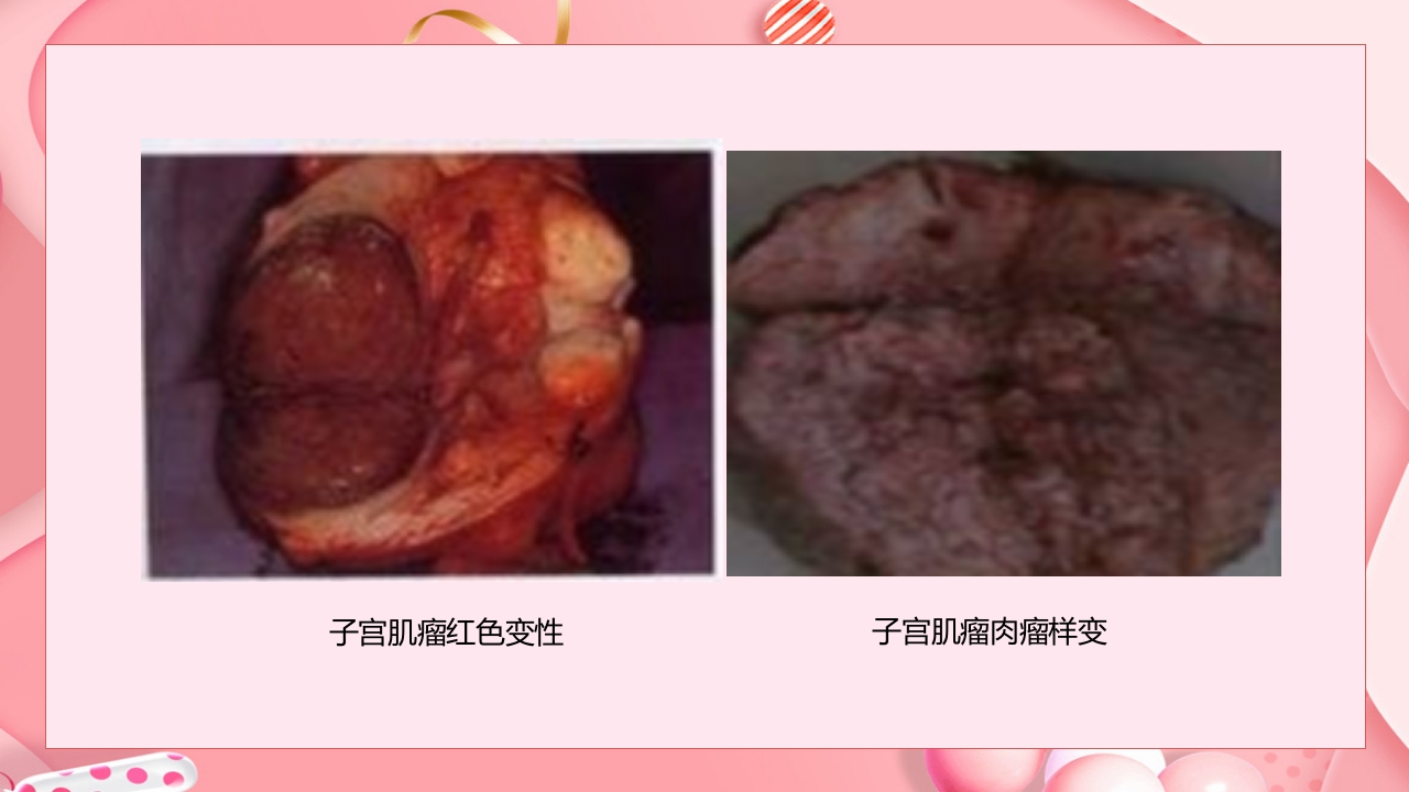 子宫肿瘤妇产科学课件ppt下载11