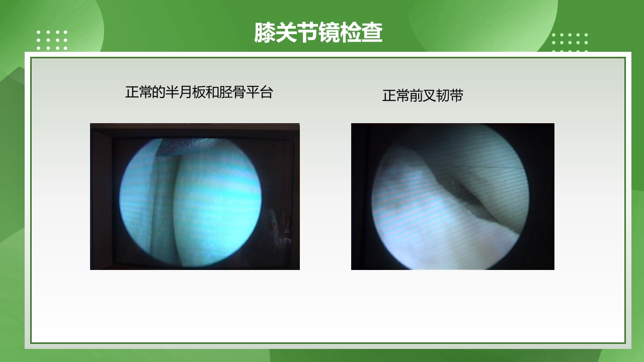 膝关节镜护理查房PPT课件下载6