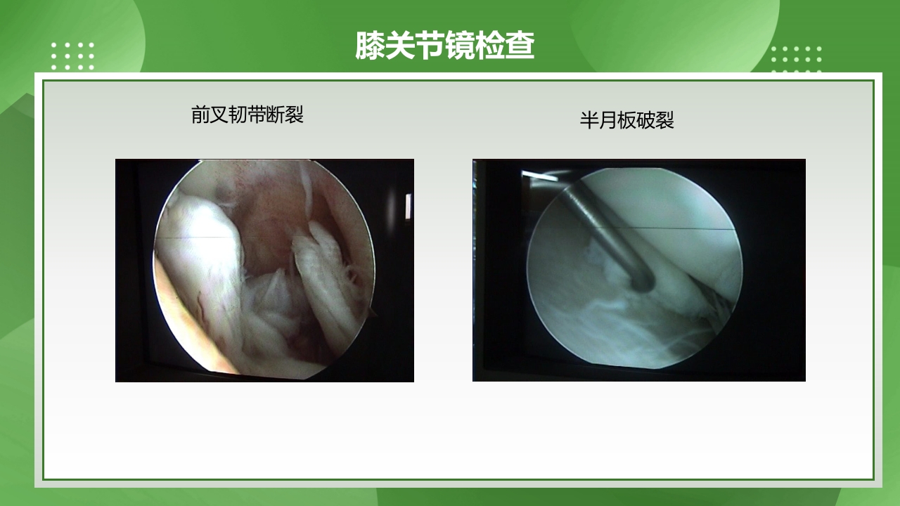 膝关节镜护理查房PPT课件下载7