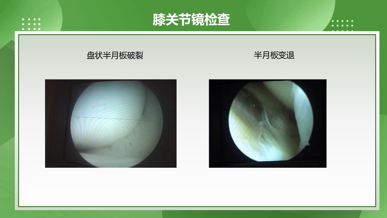 膝关节镜护理查房PPT课件下载8