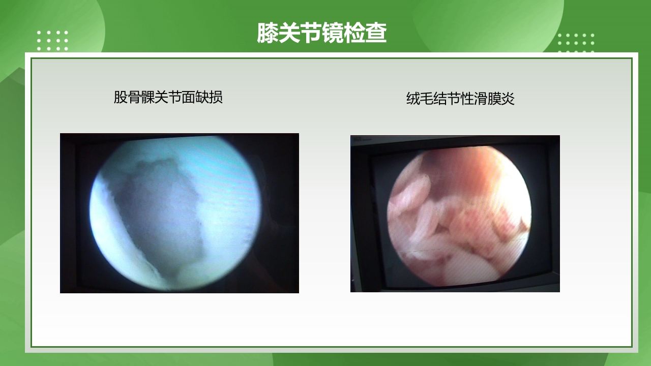 膝关节镜护理查房PPT课件下载9