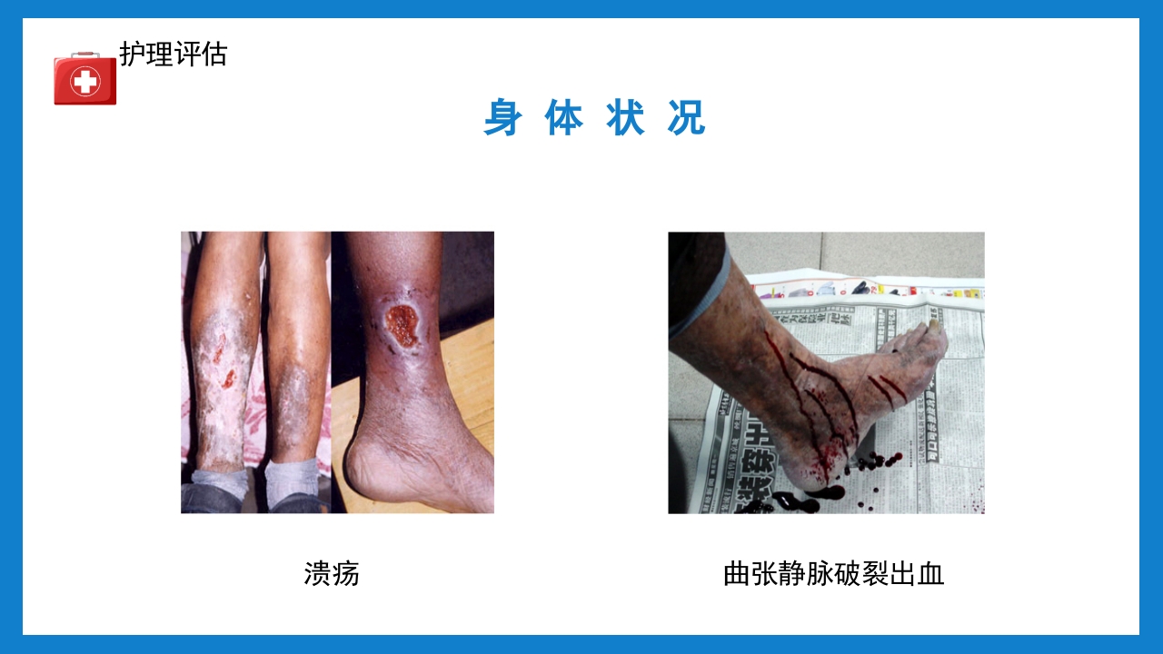周围血管疾病病人的护理培训PPT课件下载14
