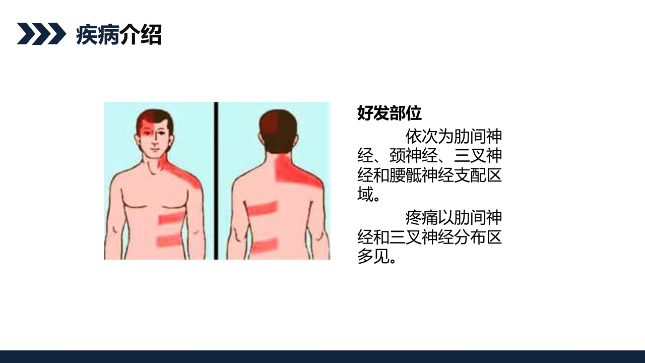 带状疱疹后遗神经痛护理查房PPT课件5