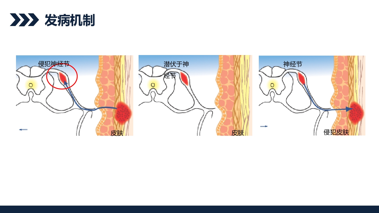 带状疱疹后遗神经痛护理查房PPT课件6